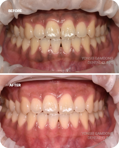 잇몸미백치료